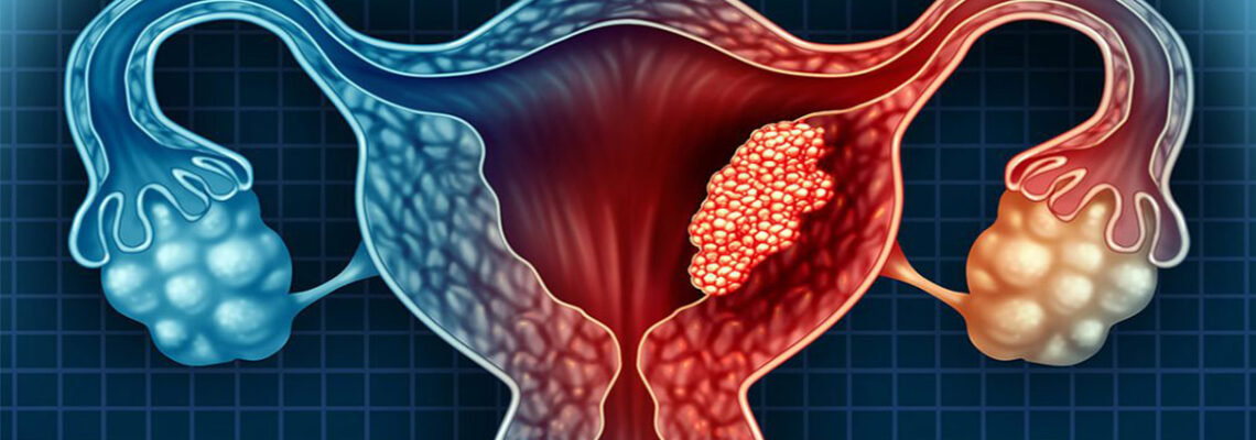 Can Myoma turn into Sarcoma?