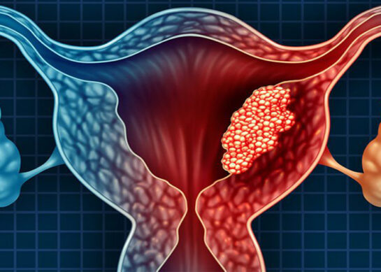 Can Myoma turn into Sarcoma?