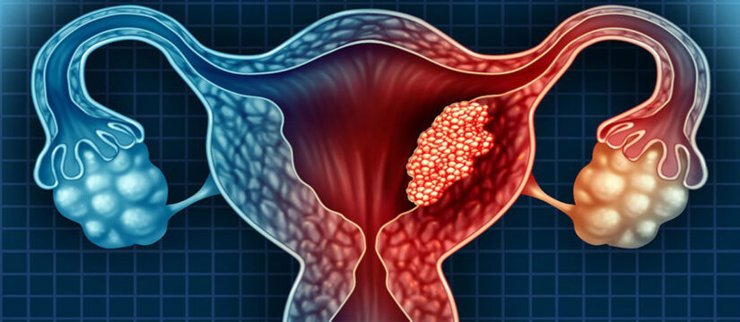 Can Myoma turn into Sarcoma?